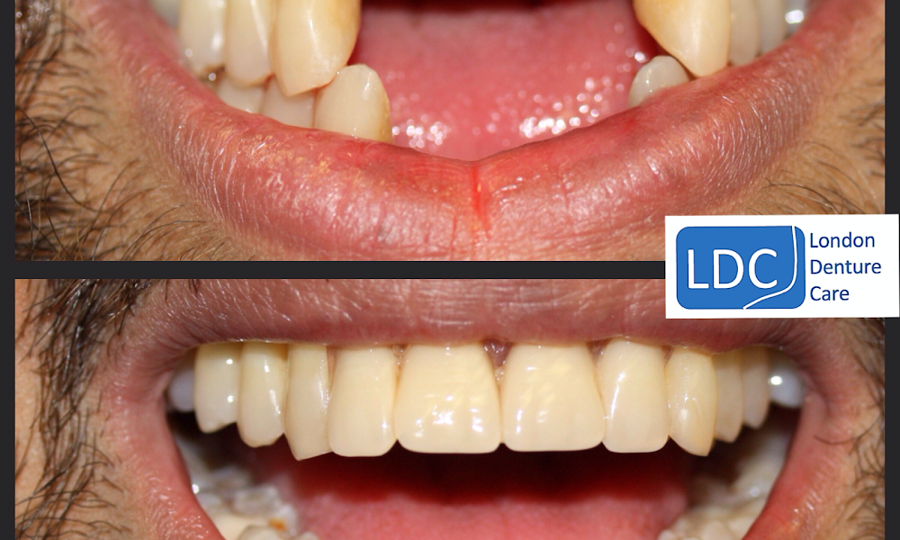 London Denture Care ( Same Day New Denture or Repairs)