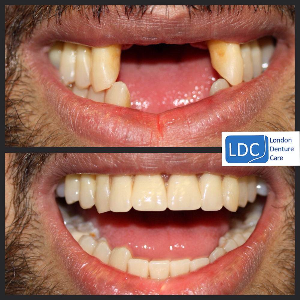 London Denture Care ( Same Day New Denture or Repairs)